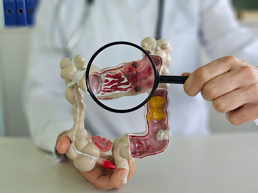 Are My Symptoms IBD or Colon Cancer? - ADH - Windsor Center for Digestive  Health